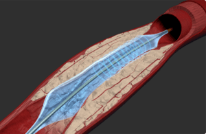 Stryker completes acquisition of Amplitude Vascular Systems